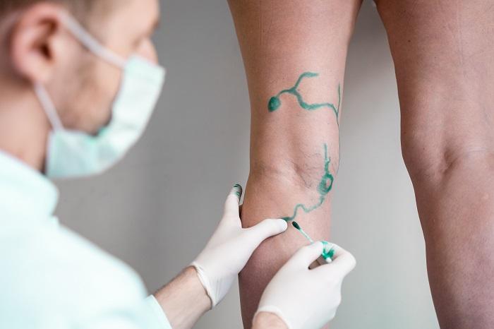 Why Would You Need Varicose Vein Surgery
